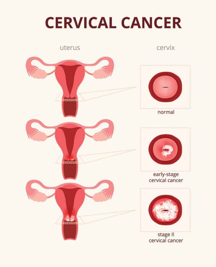 Cervical Cancer - Dr. Snita Sinukumar