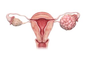 Ovarian Cancer Treatment in Pune