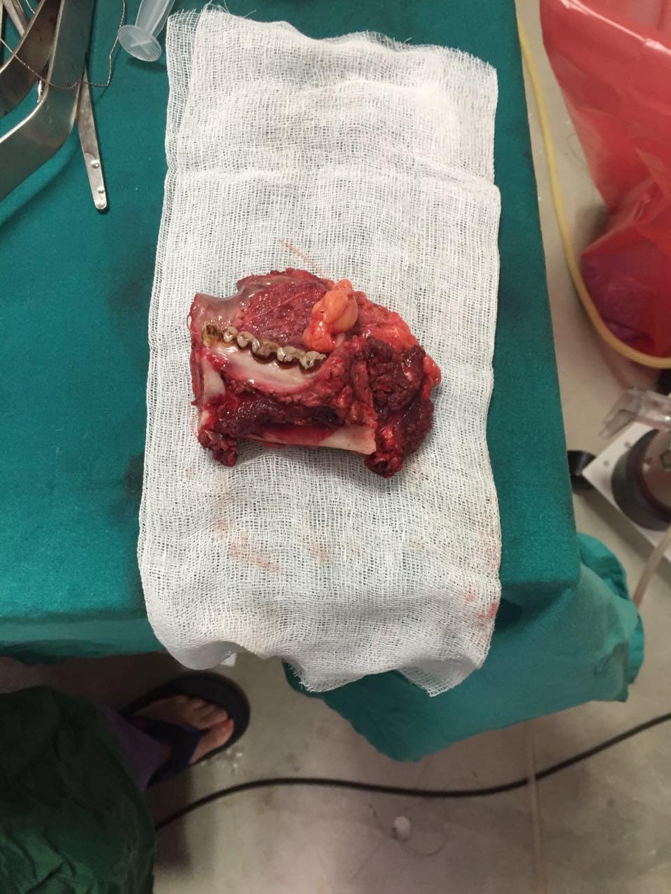 Head & Neck Cancer