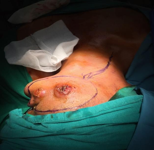 Head & Neck Cancer
