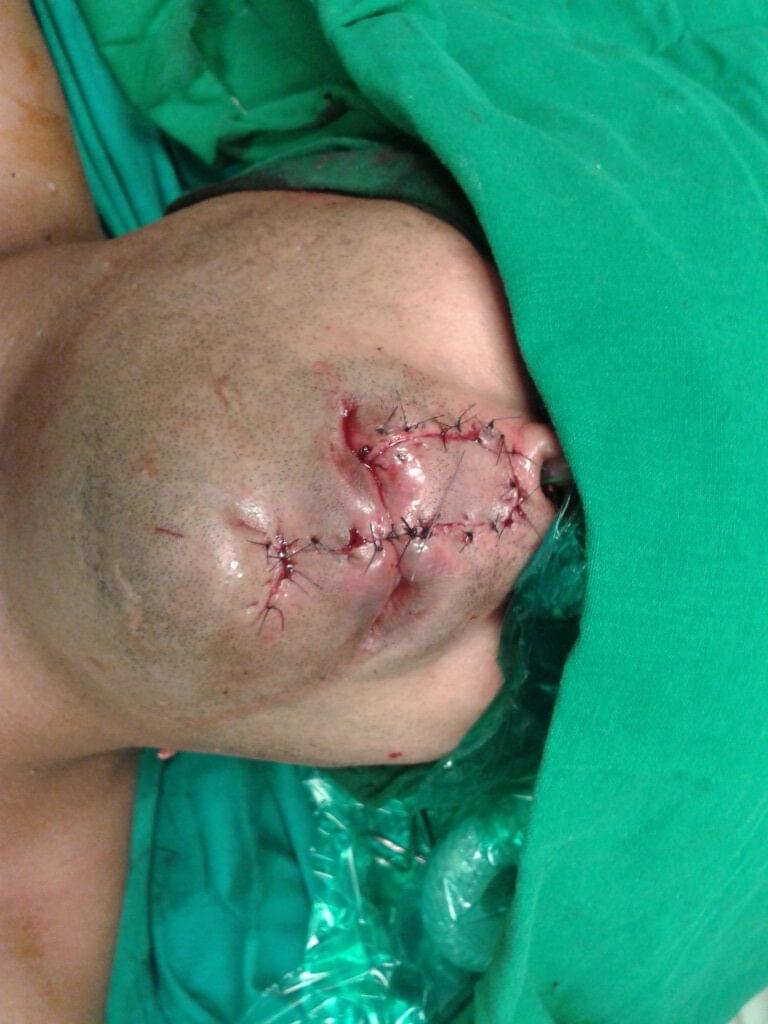 Head & Neck Cancer