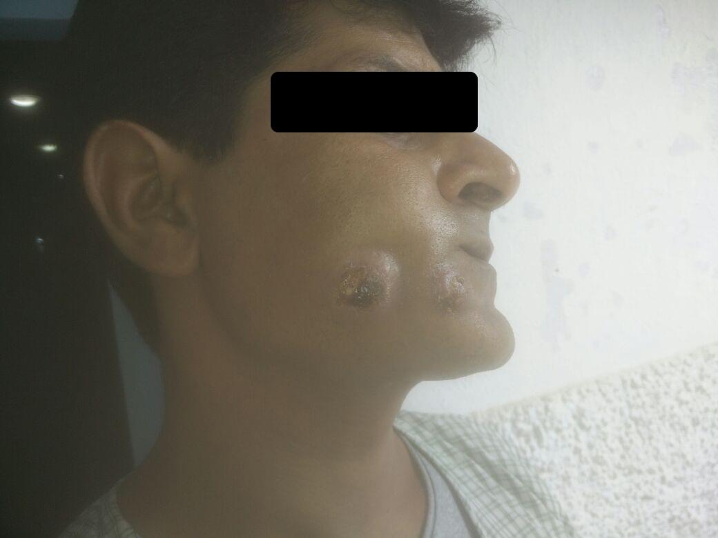 Head & Neck Cancer