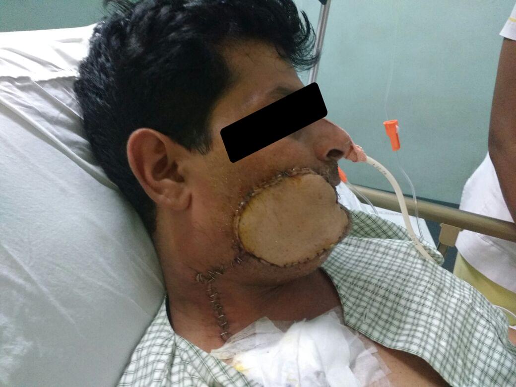 Head & Neck Cancer