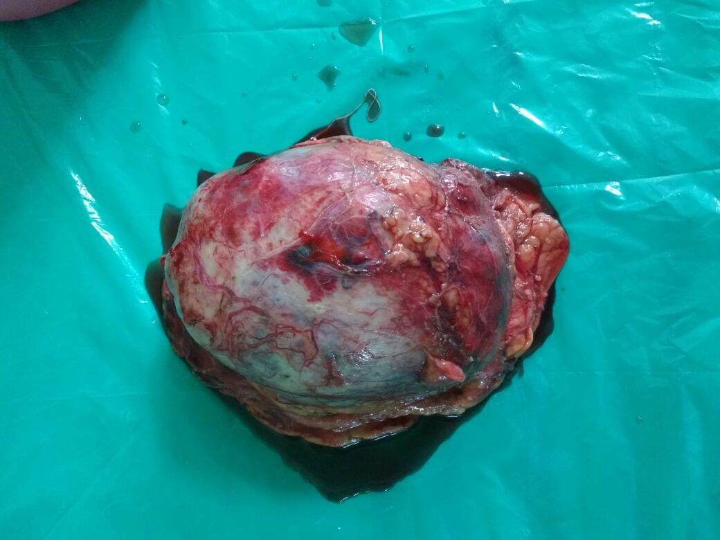 Kidney Cancer