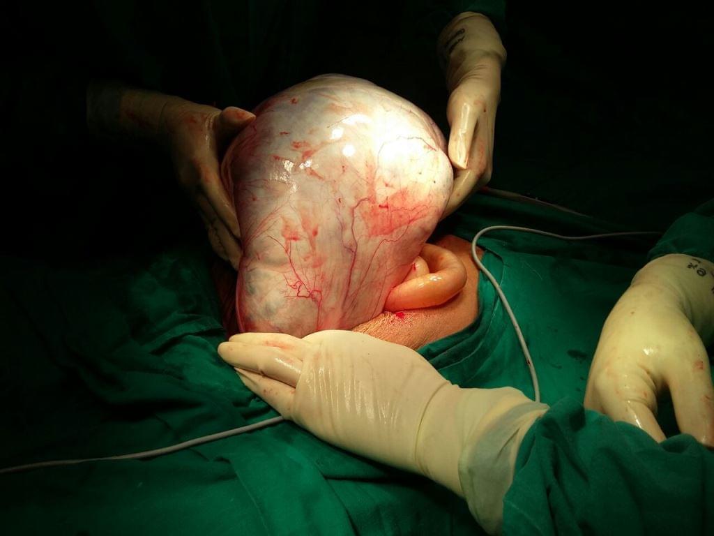 Ovarian Cancer