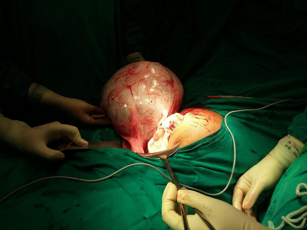 Ovarian Cancer