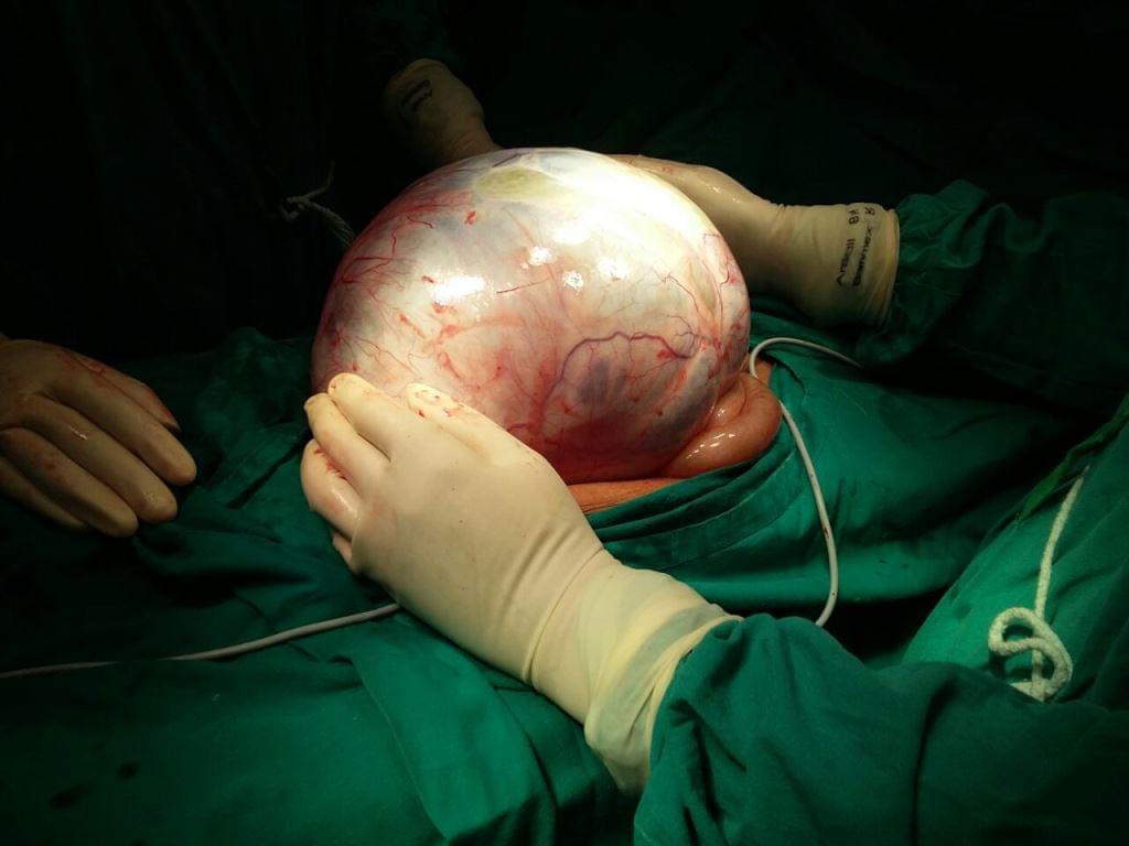 Ovarian Cancer