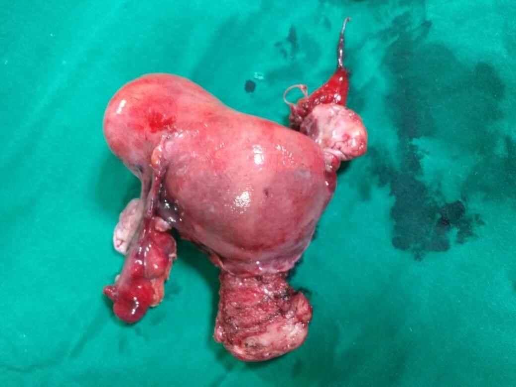 Uterus Cancer